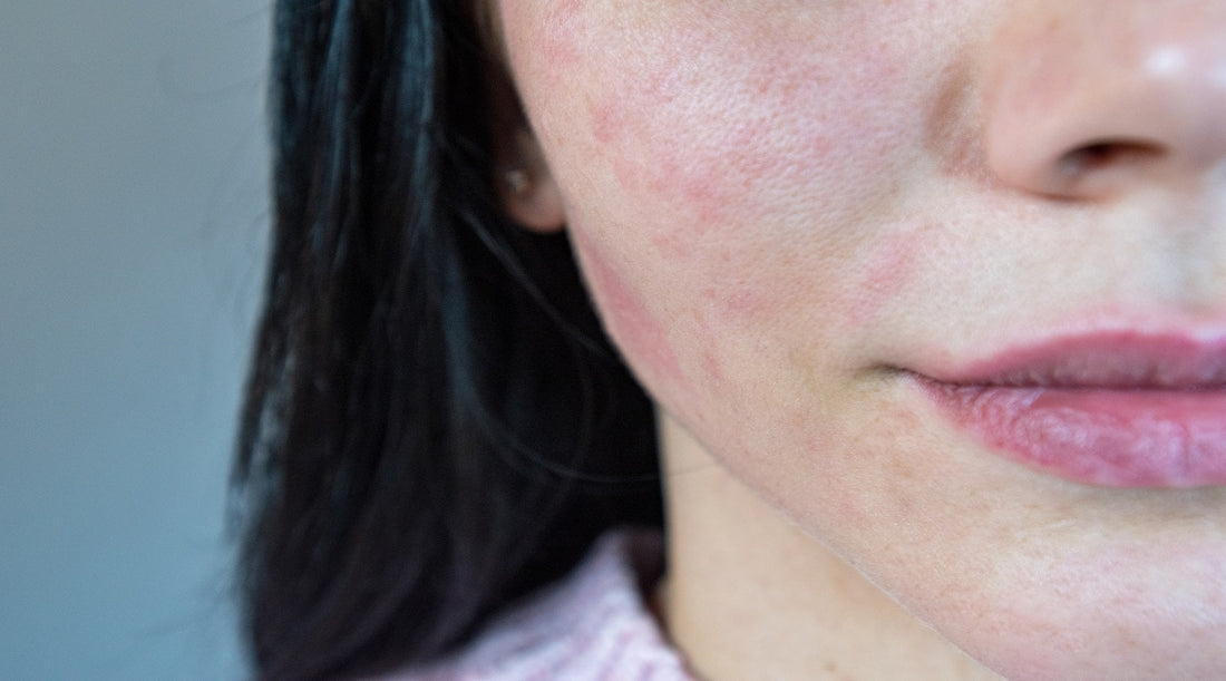 https://urpharmastore.com/cdn/shop/articles/Redness_After_Over-Exfoliating.jpg?v=1772529428&width=1100